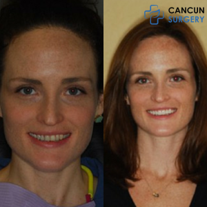 Before & After Cosmetic Smile in Cancun