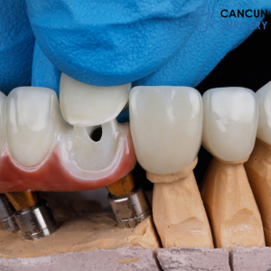 Dental Veneers in Cancun