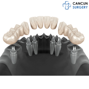 3 on 6 Dental Implants