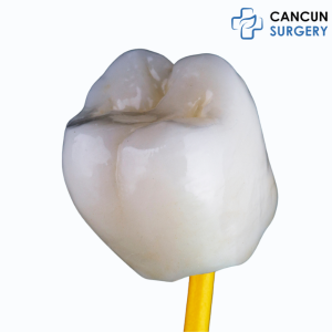 Dental Crowns in Cancun