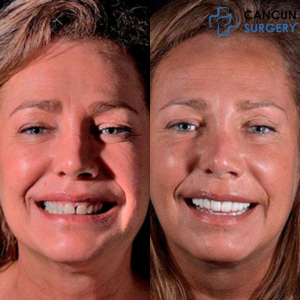 Before & After: Dental Veneers