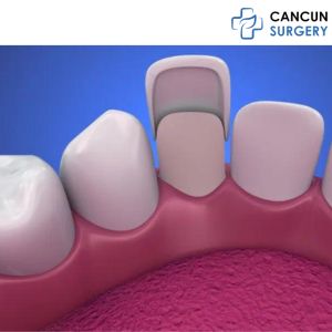 Composite Veneers in Cancun