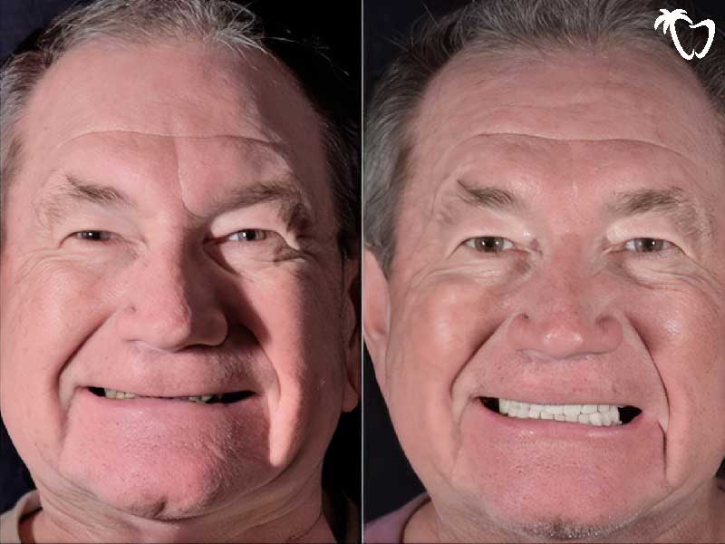 Before and After Emax Porcelain Crowns in Cancun