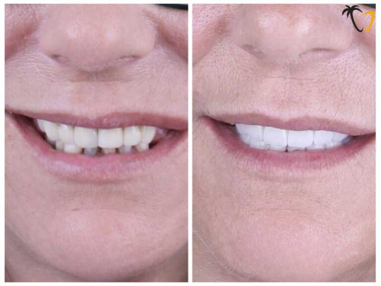 Tatjana Hatten, Alabama, US - Before & After Titanium Dental Implants Tatjana Hatten, Alabama, US - Before & After Titanium Dental Implants