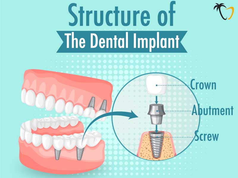 Dental Implants in Cancun: Structure Dental Implants in Cancun: Structure