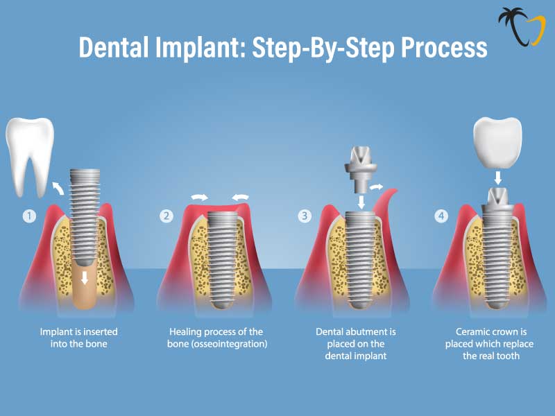 Dental Implant Complete Procedural Breakdown Dental Implant Complete Procedural Breakdown