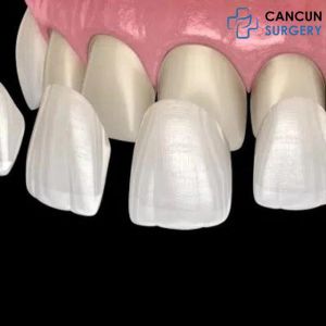 Porcelain Veneers in Cancun