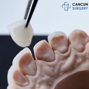 Zirconia Veneers in Cancun