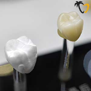 Porcelain Crowns in Cancun