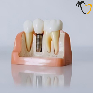 Dental Implants in Cancun