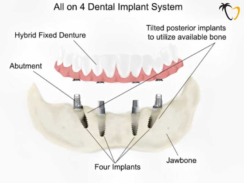 Structure of All on 4 Dental Implant in Cancun