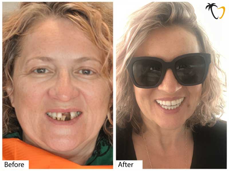 All on 6 Dental Implants in Cancun: Before & After