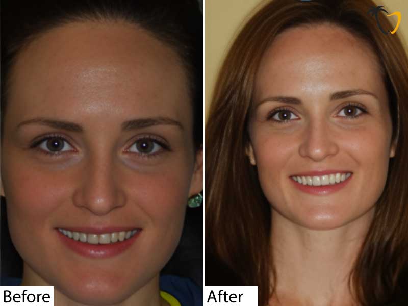 Before & After Cosmetic Smile in Cancun Before & After Cosmetic Smile in Cancun