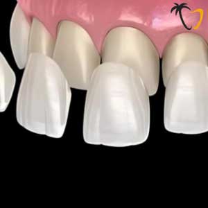 Porcelain Veneers in Cancun Porcelain Veneers