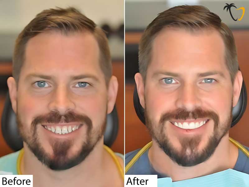 Happy Patient After Dental Veneers in Cancun Happy Patient After Dental Veneers in Cancun