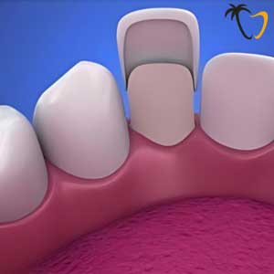 Composite Veneers in Cancun Composite Veneers