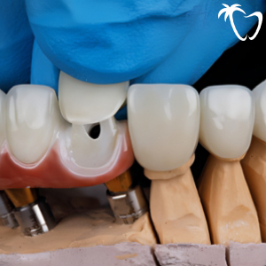 Dental Veneers in Cancun No-Prep Veneers