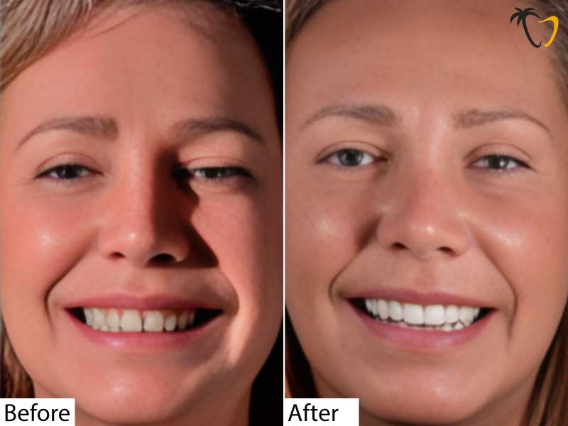 Before & After: Dental Veneers Before & After: Dental Veneers