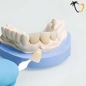 Emax Veneers in Veneers Emax Veneers